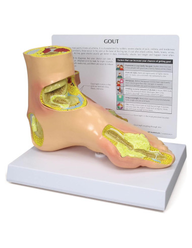 Modelo de Pie Izquierdo con Gota GPI Anatomicals 22.2x10.2cm