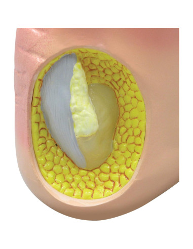 Modelo de Pie Izquierdo con Gota GPI Anatomicals 22.2x10.2cm