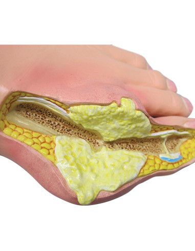 Modelo de Pie Izquierdo con Gota GPI Anatomicals 22.2x10.2cm