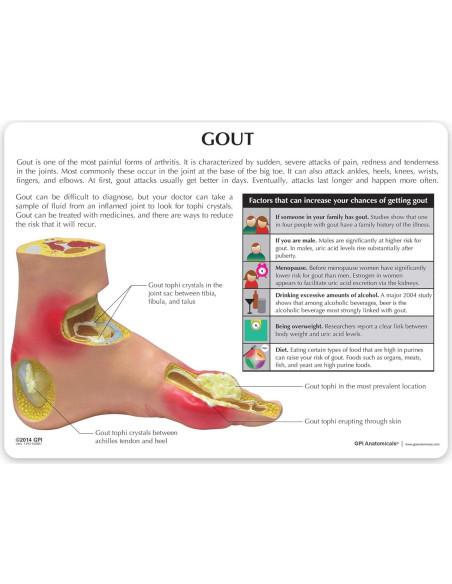 Modelo de Pie Izquierdo con Gota GPI Anatomicals 22.2x10.2cm