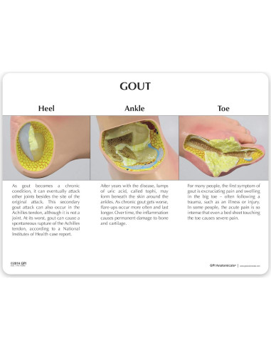 Modelo de Pie Izquierdo con Gota GPI Anatomicals 22.2x10.2cm