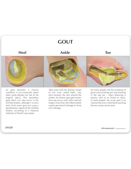 Modelo de Pie Izquierdo con Gota GPI Anatomicals 22.2x10.2cm