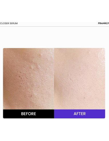 Suero Closer Frankly 30 ml | Minimizador de Poros Vegano
