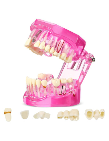 Modelo de Dientes Patológicos Rosa Outus para Educación Dental