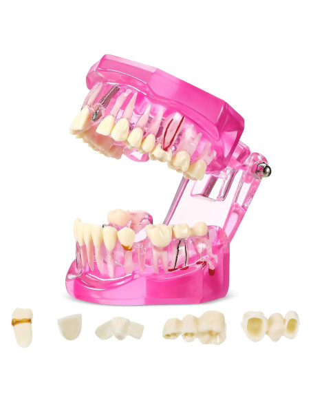 Modelo de Dientes Patológicos Rosa Outus para Educación Dental
