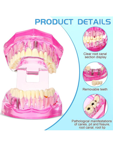 Modelo de Dientes Patológicos Rosa Outus para Educación Dental