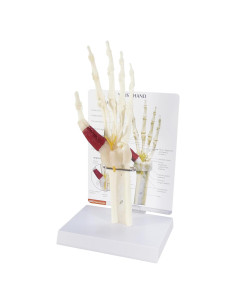 Modelo de Mano y Muñeca GPI Anatomicals con Síndrome del Túnel Carpiano