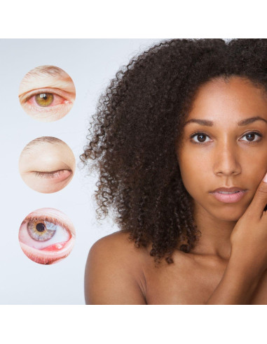 Alivio para Estilos brazzoMD - Arnica y Caléndula 30ml