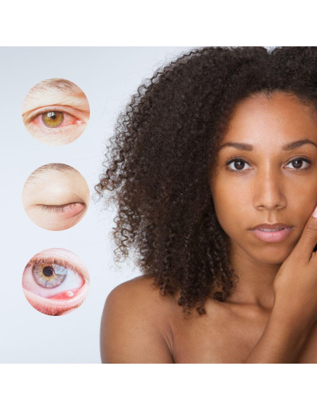 Alivio para Estilos brazzoMD - Arnica y Caléndula 30ml