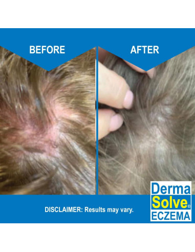 Champú y Acondicionador para Eczema Dermasolve 236.59 ml - Hidratante