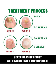 Suero Tratamiento Uñas 30 ml Peehss 7 Días Multiusos 2