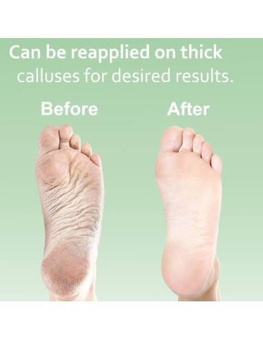 Kit de Gel Removedor de Callos Dr. Entre 226.8g + Lima y Guantes