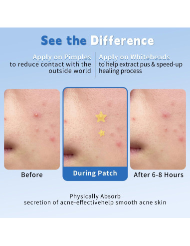 Parche Hidrocoloide para Granos Cabiuty - 200 Unidades, 3 Tamaños