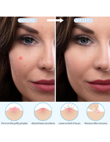 Parche Hidrocoloide para Granos Cabiuty - 200 Unidades, 3 Tamaños