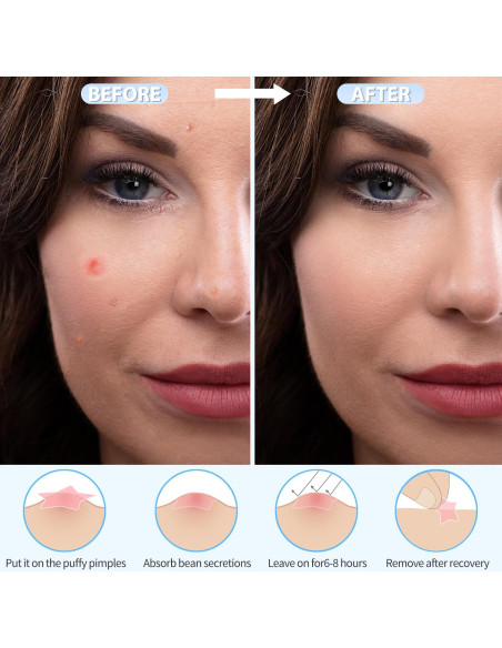 Parche Hidrocoloide para Granos Cabiuty - 200 Unidades, 3 Tamaños