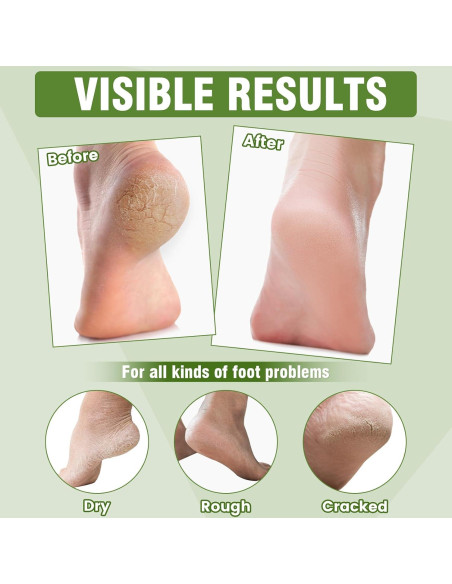 Mascarillas Hidratantes para Pies TEAWOO - 18 Pares con Karité