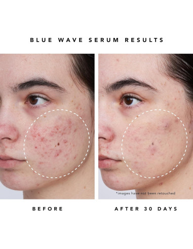 Serum Desincrustante HERBIVORE 30mL 2% Ácido Salicílico Vegano