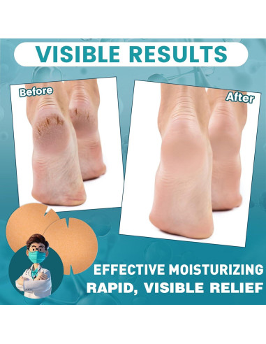 30 Parches Adhesivos TEAWOO para Talones Agrietados 80mm