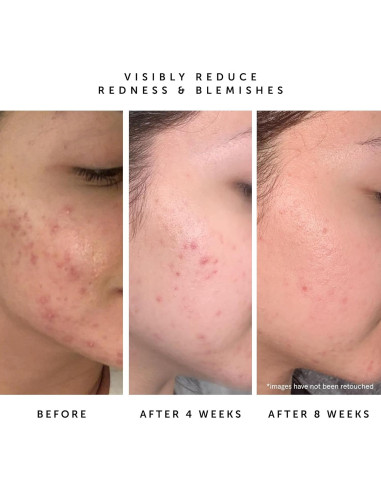 Aceite Facial Equilibrante Herbivore Lapis 50 ml - Piel Acnéica