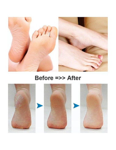 Removedor de Callos Eléctrico BOMPOW Recargable Azul