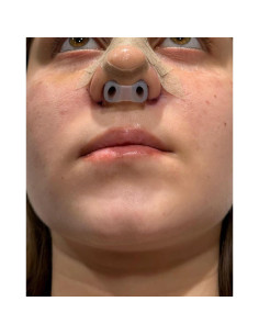 Retenedor de Nostril Footline para Recuperación de Rinoplastia 6 2