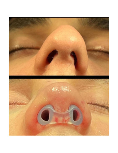 Retenedor de Nostril Footline para Recuperación de Rinoplastia 6