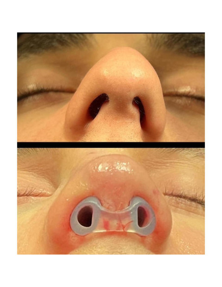 Retenedor de Nostril Footline para Recuperación de Rinoplastia 6