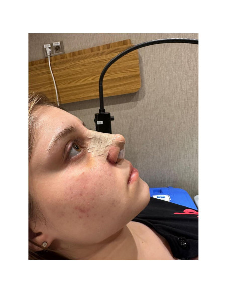 Retenedor de Nostril Footline para Recuperación de Rinoplastia 6