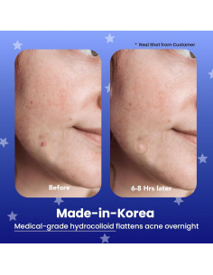 Parches para Granitos Avarelle Hidrocoloide 96 ct - Tratamiento Acné 2