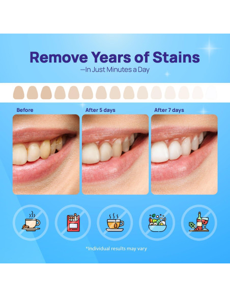 Tiras Blanqueadoras Whitebite Pro 28 Unidades - Sin Daño Esmalte