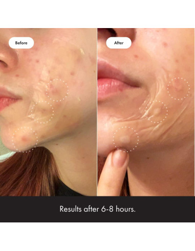 Mighty Patch Surface Hero Cosmetics - Parche acné XL 10 unidades