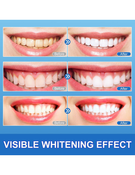 Kit de Tiras Blanqueadoras Ruduwu para Dientes Sensibles - 28 Tiras