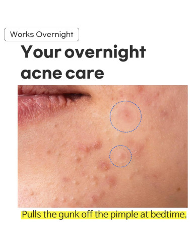 Parche Hidrocoloide TIA'M para Acné - 24 Unidades