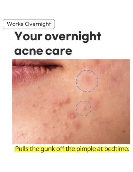 Parche Hidrocoloide TIA'M para Acné - 24 Unidades