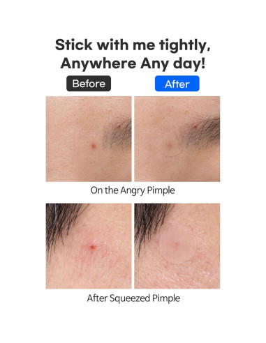 Parche Hidrocoloide TIA'M para Acné - 24 Unidades