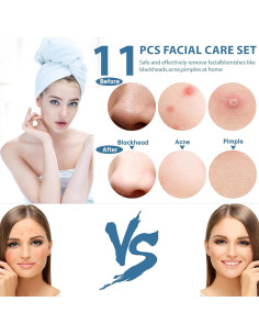 Kit de Herramientas Extractoras de Puntos Negros SBAILL 11PCS 2