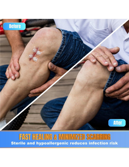 6 Vendajes Mariposa Hons para Cierre Rápido de Heridas