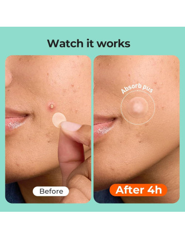 Parches para Acné TKTK Hidrocoloide 356 Unidades 6 Tamaños