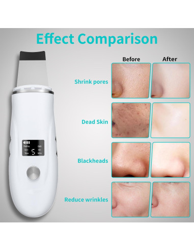 Espátula Facial QYCSL 4 en 1 - Limpieza Profunda y Exfoliación