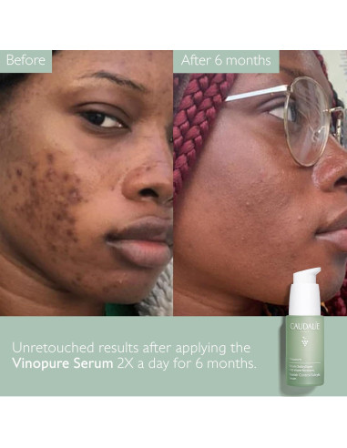 Suero Natural Caudalie Vinopure Ácido Salicílico 30 mL