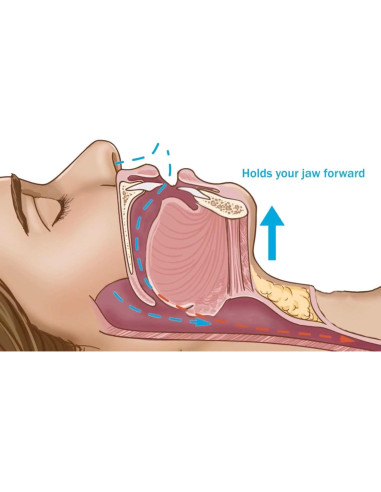 Boquilla Antirronquidos Dentemp SleepTight - Protector Bucal Personalizado