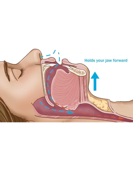 Boquilla Antirronquidos Dentemp SleepTight - Protector Bucal Personalizado