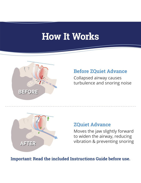 Protector Bucal Antisnoring ZQuiet Advance Ajustable 4 Tamaños