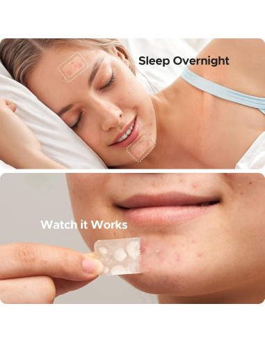 Parche Hidrocoloide para Acné TKTK - 142 Parches en 7 Tamaños