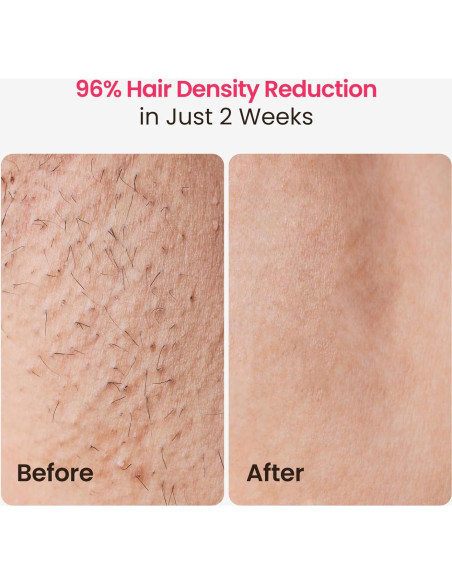 Eliminador de Vello Láser IPL Salloot Trinity iGlow 10, 12 cm