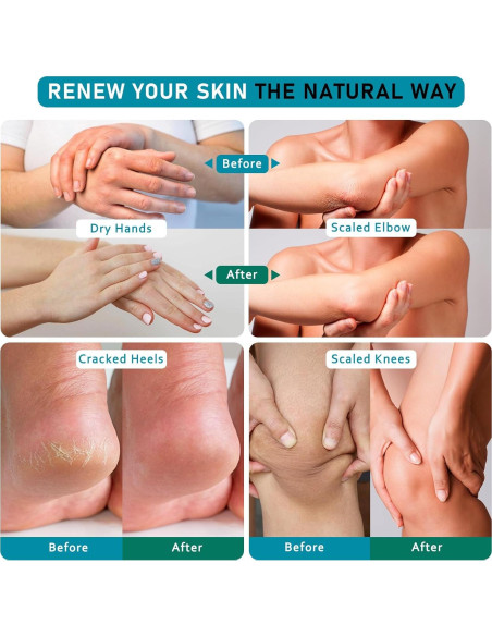 Crema de Urea 40% Aphesia para Pies Secos y Agrietados 150g