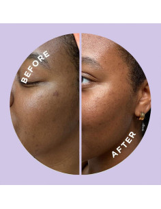 Parche Microdart ZitSticka Hyperfade para Manchas Post-Acné - 4 Unidades 2