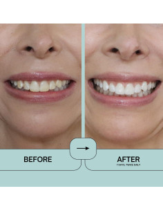 Prostrips Intelliwhite - 28 Tiras Blanqueadoras Seguras 2