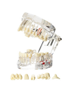 Modelo Dental Typodont Implantológico Dentalmall 2001C