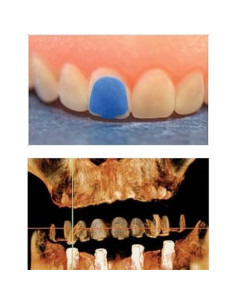 Marcadores de Cono de Rayos X Scaneez DentureMark - Paquete Inicial 2